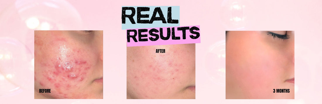 Real Results: How Augusta’s Skin Transformed with Helloskin’s Skincare & V3.0 LED Therapy