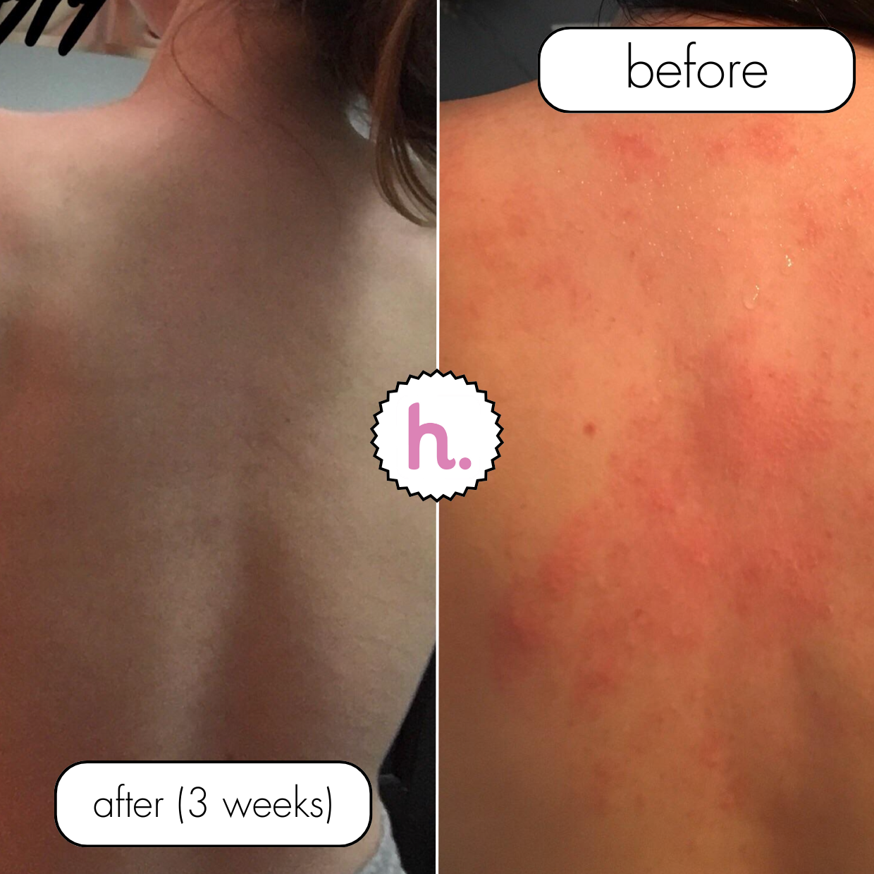 No Filter / Azelaic Acid 20% w/w Body Moisturiser